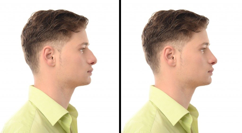 Young Man with Nose Job