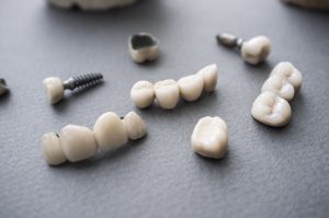 Teeth Implants