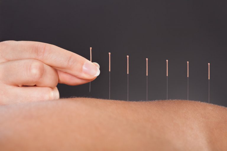 History Of Acupuncture: From Tradition To Modern Medicine ...